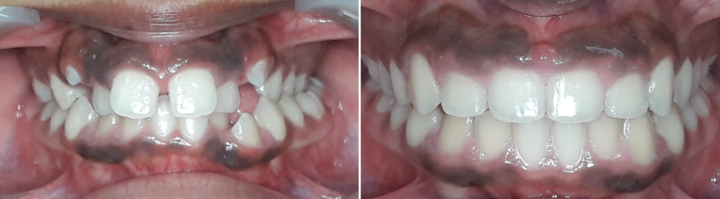 blog ortho billet wat doet een orthodontist