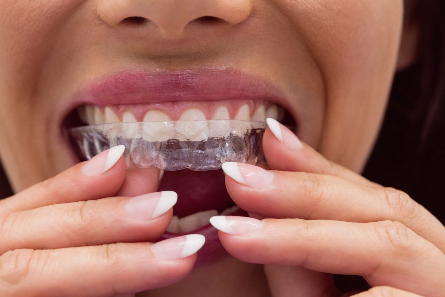 Wat is een nachtbeugel? Ortho Billet