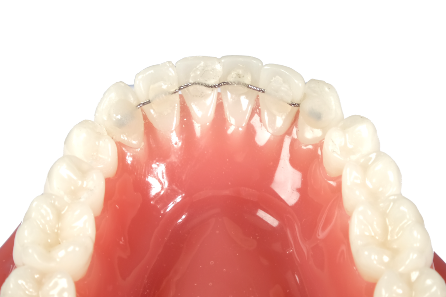Orthodontieprakijk Ortho Billet spalk retainer na beugel copyright