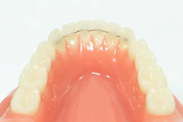 Orthodontieprakijk Ortho Billet spalk retainer na beugel