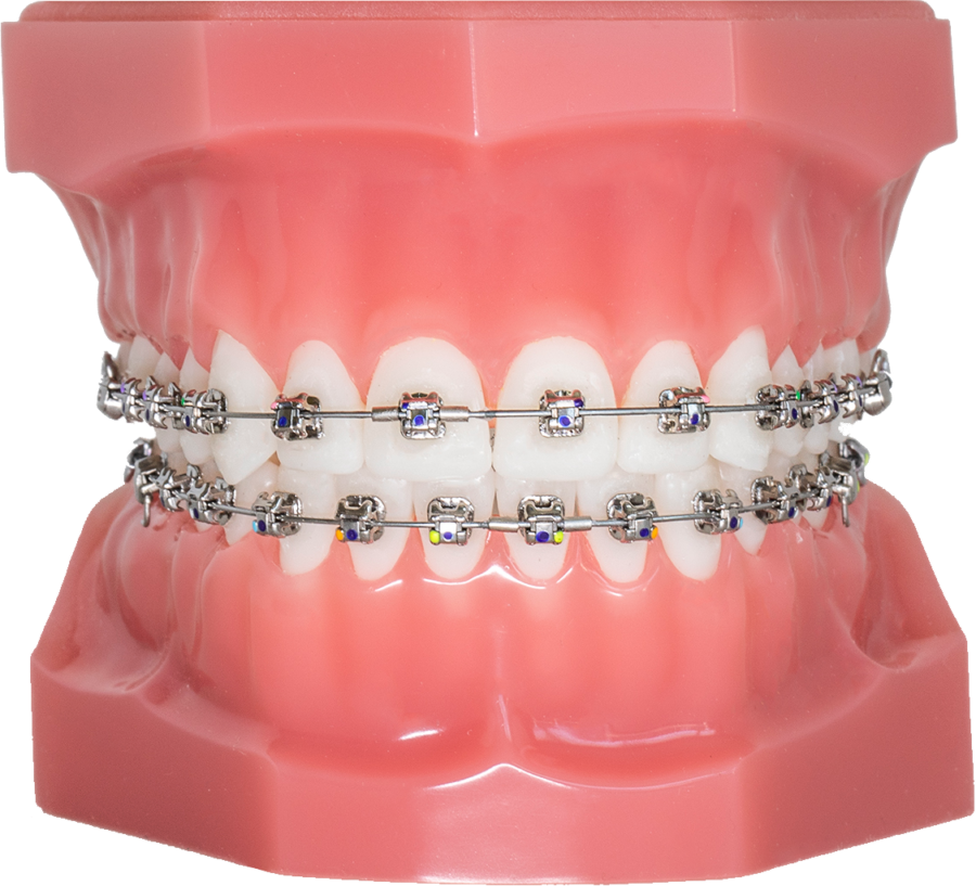 Orthodontiepraktijk Ortho Billet Damon Ultima vaste plakkertjes slotjes beugel small