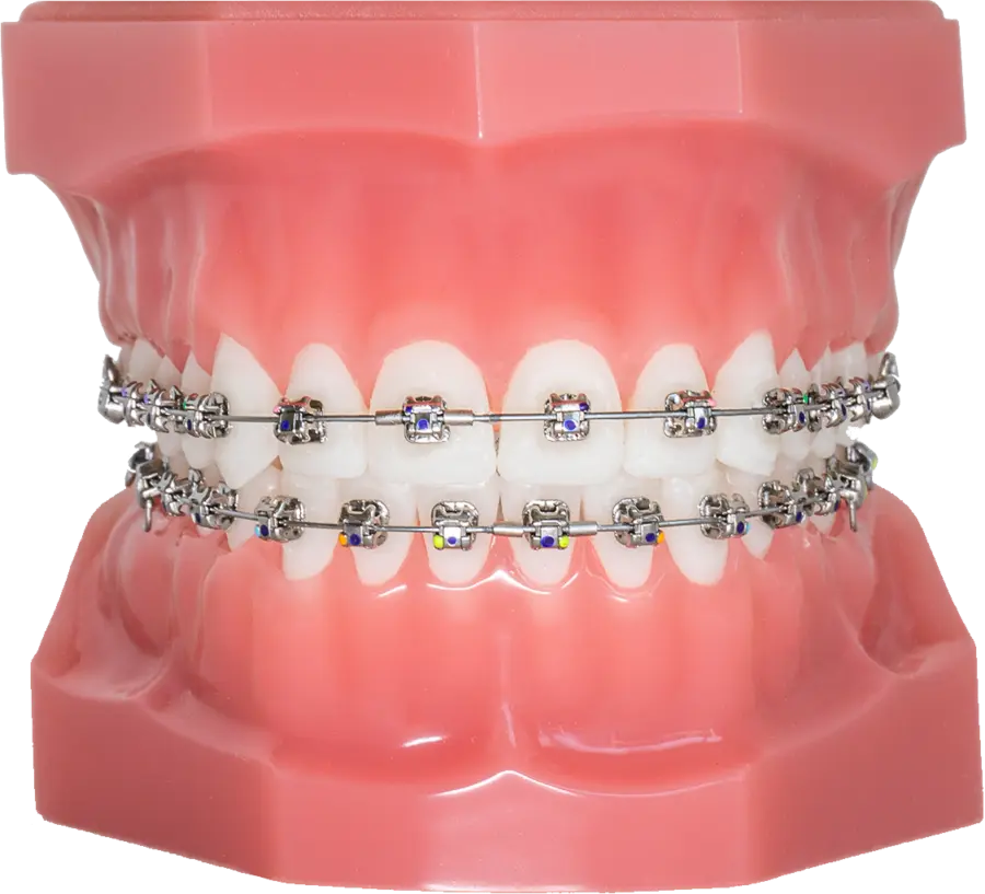 Vaste metalen beugel - orthodontist Ortho Billet Vlaardingen Maassluis 's-Gravenzande